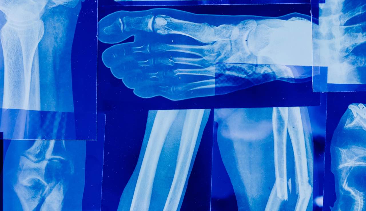 ossa rotte lastra - pexels- terranauta